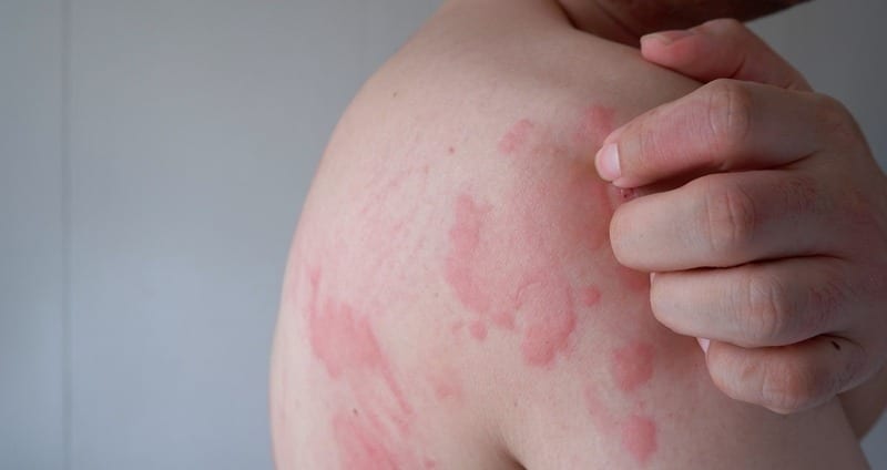 When Should I Seek Urgent Care For A Rash